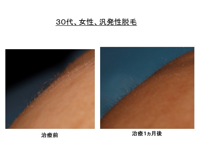 円形脱毛症　病院